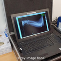 X-ray image bone